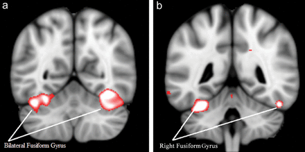 Effective connectivity from the amygdala in healthy control participants during approachability judgments. Participants show effective connectivity between (a) left amygdala and fusiform gyrus/cerebellum and (b) right amygdala and fusiform gyrus/cerebellum.