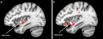 Reduced connectivity from (a) left amygdala and (b) right amygdala to the right insula in patients compared with controls.