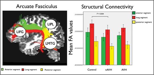 The 3 segments of the arcuate fasciculus (AF) connecting left inferior frontal gyrus (LIFG), left middle temporal gyrus (LMTG), and left inferior parietal lobe (LIPL) within the perisylvian language network (left). Group-specific mean fractional anisotropy (FA) values for each segment of the AF and significant group difference between healthy controls and the nonauditory verbal hallucinations (nAVH) group (right). Error bars indicate 95% CI.