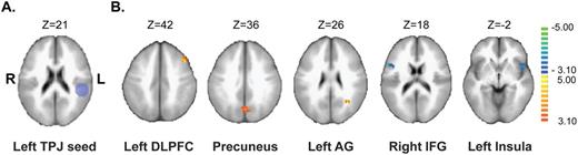 Effects of transcranial Direct Current stimulation (tDCS) on seed-based resting-state functional connectivity (rs-FC) of the left temporo-parietal junction in patients with schizophrenia suffering from auditory hallucinations ( N = 23). (A) Projection of the left temporo-parietal junction seed over the ICBM brain template. (B) Comparison of the seed-based rs-FC changes after tDCS according to the patient group (the contrast (after active tDCS > before active tDCS) > (after sham tDCS > before sham tDCS)) is presented in volume space. Slice-views synthesize contrast maps obtained after volumetric normalization (Talairach), overlaid over the ICBM-152 brain template. Analysis of the left Temporal-Parietal Junction seed-based rs-FC revealed a significant increase in rs-FC after active tDCS when compared with sham mainly with the left dorsolateral prefrontal cortex (DLPFC), the precuneus and the left angular gyrus (AG) and a significant decrease in rs-FC within inferior frontal regions including the right inferior frontal gyrus (IFG) and the left anterior insula.