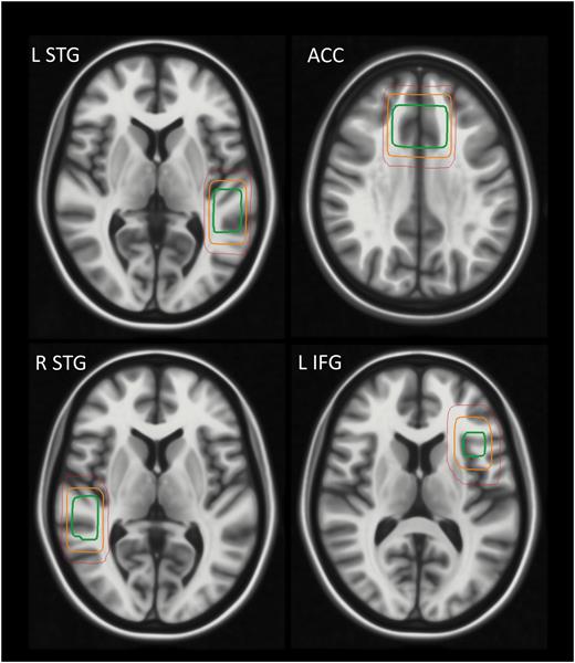 Placement of voxels in the left STG, ACC (across midline), right STG, and left IFG shown in horizontal views. Center-of-mass for the voxel localization, given in MNI space x, y, z coordinates for the left IFG: −36.8, 18.9, 11.9, left STG: −48.3, −35.9, 6.02, right STG: 50.2, −34.2, 6.11, and for the ACC: 0.389, 25.4, 33.9. The orange box illustrates the placement for a single representative subject. The red contours indicate 95%, and the green contours indicate 65% confidence regions for placement across the entire group (when mapped to a standard template). LSTG, left superior temporal gyrus; LIFG, left inferior frontal gyrus; ACC, anterior cingulate cortex; RSTG, right superior temporal gyrus.