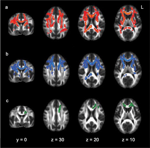 The TBSS image shows the linear relationships between NES total score and different parameters of white matter integrity: (a) axial diffusivity (b) mean diffusivity, (c) radial diffusivity. Significant clusters are thickened for visual purposes and are indicated in different colors at P < .05, FWE corrected, projected on a standardized diffusion-weighted image (FMRIB58_FA). Y and Z indicate the coordinates of the image slices in mm.