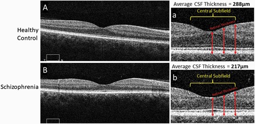 Comparison of macular thickness, from OCT images, between a healthy control and subject with schizophrenia.Representative 6 mm OCT scans of the retina in both a healthy control (A) and subject with schizophrenia (B), along with enlarged images of the central portion of the scans (a, b) respectively. Alternating darker and lighter bands seen in the scans represent unique layers in the retina. The central subfield is a 1 mm central section of the scan. Retinal thickness at different points in the scan are measured from the superficial internal limiting membrane to the deep retinal pigment epithelium (arrows). The thickness at multiple corresponding points are appreciably thinner in the schizophrenia scan. The average central subfield thickness is calculated on the OCT device by averaging the retinal thickness at many points in a central circular area of retinal tissue measuring 1 mm in diameter. In these images the thickness of the macula central subfield is 217 microns for the person with schizophrenia and 288 microns for the control subject. OCT, optical coherence tomography.