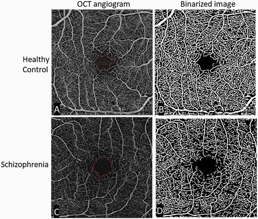 Comparison of retinal microvasculature, from OCTA images, between a healthy control and a subject with schizophrenia.Original and binarized OCT angiograms of a patient with schizophrenia and a healthy control. A standard OCT angiogram of a healthy eye is seen in (A). Vessels are seen in white, with larger arterioles and smaller capillaries represented in the 3 × 3 mm2 window. The foveal avascular zone (the most central region of the macula, where blood vessels are not present) is delineated in red. (B): A binarized version of the same angiogram, allowing for easier qualitative and quantitative assessment of vascular density. The bottom row shows similar images from a patient with schizophrenia. Compared to the healthy control, there is an enlargement of the foveal avascular zone (typically reflecting loss of microvasculature in the surrounding area) and a decrease in vessel density (C) most easily appreciated in the binarized image (D). OCT, optical coherence tomography; OCTA, OCT angiography; Figure reproduced from Green KM, Choi JJ, Ramchandran RS, Silverstein SM. OCT and OCT angiography offer new insights and opportunities in schizophrenia research and treatment. Front Digit Health. 2022;4:836851. doi:10.3389/fdgth.2022.836851 via a creative commons license (CC BY 4.0).