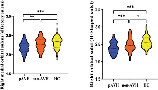 Bonferroni corrected violin graphs of cortical thickness of brain regions with significant differences among the 3 groups. Note: pAVH, persistent auditory verbal hallucination; non-AVH, without auditory verbal hallucination; HC, health control. **P < .01; ***P < .001; ns, not significant (P > .05). Bonferroni correction was used for ANCOVA (P < .05/148 = .00034) and multiple comparisons (P < .05/17 = .003).