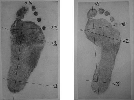  Pedography: Above left is a First World War pedographic example of flat feet, while above right is an imprint of a normally arched foot, evinced by the concavity of the instep. Source : Photographic reproductions are courtesy of the US National Archives and Records Administration, College Park, Maryland, Record Group 112, Box 430, file 730. 