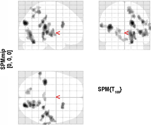 The activated regions in the first spatial fMRI pattern. These regions were similarly activated for both the Active-sd and the Sham-sd groups in the Day 3 – Baseline contrast.