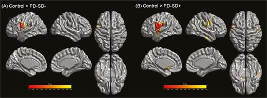 Analysis of cortical thickness. (A) Parkinson’s disease (PD) patients without sleep disturbance exhibited reduced cortical thickness in the left frontoparietal regions relative to controls. (B) PD patients with sleep disturbance showed cortical thinning in more extensive areas compared to controls, including the bilateral frontoparietal and lateral temporal regions (RFT-corrected p < .05). There were no areas of significantly different cortical thickness between PD patients with and without sleep disturbance. Abbreviations: PD-SD−, PD without sleep disturbance; PD-SD+, PD with sleep disturbance.