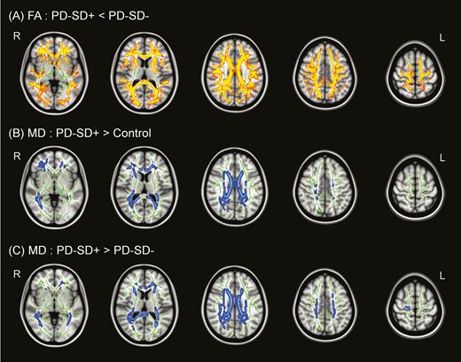 Tract-based spatial statistics (TBSS) analysis. (A) Parkinson’s disease (PD) patients with sleep disturbance showed significantly lower fractional anisotropy (FA) values in widespread regions than those without sleep disturbance. PD patients with sleep disturbance also showed higher mean diffusivity (MD) values than both controls (B) and PD patients without sleep disturbance (C) in widespread regions (FWE-corrected p < .05), where decreased FA and increased MD values are indicative of white matter (WM) disintegration. There were no significant differences between PD patients without sleep disturbance and controls.