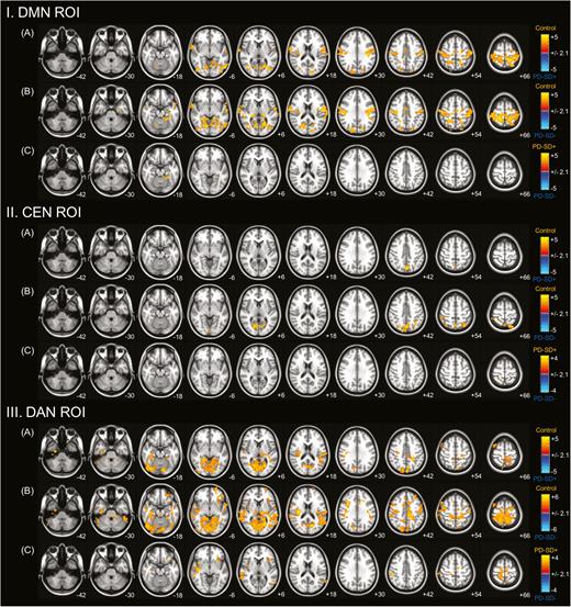 Comparison of resting-state functional connectivity with regions of interest (ROIs). ROIs in the posterior cingulate cortex (PCC) or default mode network (DMN), dorsolateral prefrontal cortex/posterior parietal cortex (DLPFC/PPC) or central executive network (CEN), and intraparietal sulcus/frontal eye field (IPS/FEF) or dorsal attention network (DAN). Groupwise comparisons between Parkinson’s disease (PD) patients with sleep disturbance and controls (A); PD patients without sleep disturbance and controls (B); and PD patients with and without sleep disturbance (C) are shown. PD patients exhibited decreased functional connectivity in sensorimotor and visual cortical areas from seed ROIs in the DMN (I) and DAN (III) and in parieatal areas from a seed ROI in the CEN (II) compared with controls. In a direct comparison, nondemented PD patients with sleep disturbance demonstrated less severely decreased functional connectivity from the seed ROIs than those without sleep disturbance.