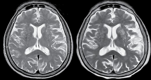 T2-weighted MRI of a 75-year-old man with long COVID-related persistent poor sleep quality. There is a marked increase in the burden of enlarged basal ganglia-perivascular spaces between baseline (left) and follow-up (right) MRIs.