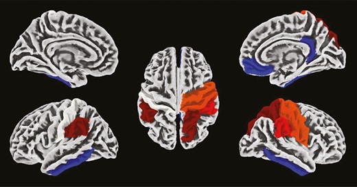 Difference in cortical gyrification between young and older individuals. Hot colors represent brain regions showing higher gyrification in the young group than in the older group. Cold colors represent brain regions showing lower gyrification in the young group than in the older group. Cortical parcellation was obtained with the Desikan Kiliany atlas, and results are overlaid on an MNI template.