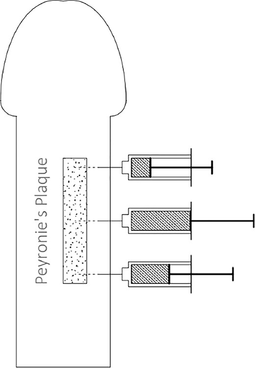 CCH injection method.