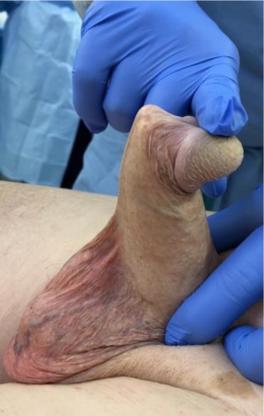 Flail penis, or severe glans hypermobility, secondary to undersized cylinders.