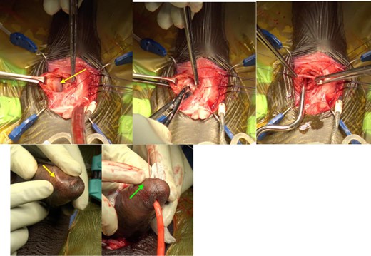 A. Exposure of the posterior wall of the surgical pseudo-capsule (yellow arrow). B. Posterior wall of the surgical pseudo-capsule is incised and opened until the corporal sinusoidal tissue is identified. C. Dilation of the new extracapsular space. D. Before and after pictures of the point of impending cylinder erosion (yellow arrow) and proper cylinder replacement after ECT (green arrow).