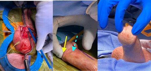 A. Brooks Dilator is present in the new extracapsular space while the measuring stick is in the original intra-capsular space. B. Close up image demonstrates the difference between the extracapsular space (yellow solid arrow) vs the intracapsular space (blue dotted arrow). C. Proper placement of bilateral cylinders after ECT.