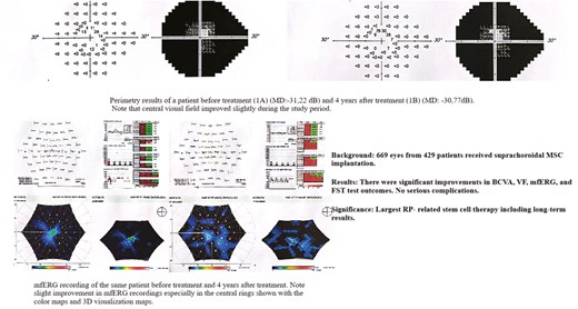 Evaluating the long-term efficacy of umbilical cord-derived mesenchymal stem cell therapy in retinitis pigmentosa: findings from a 1-to-4-year follow-up Evaluating the long-term efficacy of umbilical cord-derived mesenchymal stem cell therapy in retinitis pigmentosa: findings from a 1-to-4-year follow-up