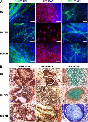 In vitro and in vivo differentiation capacity of human embryonic stem cell (hESC), NHDF-derived control-induced pluripotent stem cell (iPSC), and HLHS-iPSC lines. (A): In vitro differentiation capacity to all three germ layers demonstrated by immunocytochemical staining with an anti-AFP antibody (endoderm), anti-CD31 antibody (mesoderm), and anti-βIII-tubulin antibody TUJ1 (ectoderm). DAPI staining of nuclei is shown in blue. Shown is a representative example of at least three independent experiments. Scale bar = 100 μm. (B): In vivo differentiation of hESC line H9 (upper panel), NHDF1-iPSCs (middle panel), and HLHS1-iPSCs (lower panel). All three pluripotent stem cell lines produced teratomas containing structures representative of each germ layer, notably neuroepithelium (Ba, Bd, Bg) (ectoderm), kidney (Bb, Be)/gut (Bh) wall (both endoderm), and cartilage (Bc, Bf, Bi) (mesoderm). Histological staining: Masson's trichrome for iPSC-HLHS mesoderm and Weigert's stain for all other sections. Scale bars = 150 µm (NHDF1-iPSCs and iPSC-HLHS) and 75 µm (all others). Abbreviations: AFP, α-fetoprotein; DAPI, 4′,6-diamidino-2-phenylindole; HLHS, hypoplastic left heart syndrome; NHDF, neonatal human dermal fibroblast.
