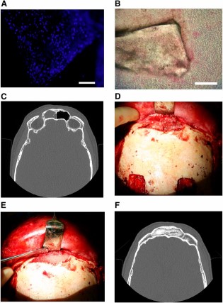 Collage of frontal sinus treatment. (A): 4′,6-diamidino-2-phenylindole nuclear staining image of bioactive glass granules seeded with adipose stem cells (BonAlive). Scale bar = 1 mm. (B): Alkaline phosphatase staining of a bioactive glass granule seeded with adipose stem cells (BonAlive). Scale bar = 1 mm. (C): Preoperative computed tomography (CT) scan of the left frontal sinus demonstrating mucosal changes and frontal sinusitis. (D): Clinical photograph of exposed diseased frontal sinus with purulent mucosa. (E): Clinical photograph of debrided frontal sinus packed with granules of bioactive glass seeded with autologous adipose-derived stem cells. (F): Postoperative CT scan of the frontal sinus obliterated with autologous adipose stem cell-seeded bioactive glass 28 months following surgery with no resorption of the construct.