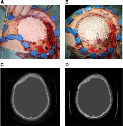 Collage of cranial defect cases. (A): Meningioma resection site filled with autologous adipose stem cell-seeded β-tricalcium phosphate (β-TCP) granules. (B): Titanium containment mesh on top of stem cell-seeded β-TCP granules to keep granules from migrating. (C): Immediate postoperative cranial computed tomography (CT) scan showing titanium containment mesh and adipose-derived stem cell-seeded β-TCP granular construct. (D): Postoperative cranial CT taken 28 months following surgery with signs of integration of the cranioplasty construct.