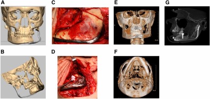 Collage of mandibular reconstructions. (A): Virtual preoperative planning using Romexis software with computer-generated image of patient with large mandibular ameloblastoma showing the reconstruction plate over the area planned for resection from an anterior view. (B): Computer-generated image of patient with large mandibular ameloblastoma showing the reconstruction plate over the area planned for resection from a medial view. (C): Intraoperative photograph showing reconstruction plate in position and resection lines on mandibular ramus posteriorly and body anteriorly. (D): Intraoperative photograph with adipose-derived stem cell-seeded β-tricalcium phosphate (β-TCP) granular construct with recombinant human bone morphogenetic protein-2 (rhBMP-2) being placed beneath titanium containment mesh at mandibular resection site. (E): Postoperative three-dimensional (3D) computed tomography (CT) scan anterior view of the regenerated left body and ramus of the mandible 12 months after reconstruction. (F): Postoperative 3D CT scan basilar view of the regenerated left body and ramus of the mandible 12 months after reconstruction. (G): Cone beam CT scan showing mandibular reconstruction using autologous adipose-derived stem cell-seeded β-TCP granular construct with rhBMP-2 restored with successful functionally loaded dental implant in the regenerated bone.