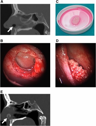 Collage of nasal septal perforation treatment. (A): Preoperative computed tomography (CT) scan in the sagittal plane revealing chronic nasal septal perforation before repair (arrow). (B): Intraoperative endoscopic view of chronic nasal septal perforation with margins incised. (C): Autologous adipose stem cell-seeded resorbable scaffold composed of β-tricalcium phosphate (β-TCP) and ε-polycaprolactone ready for implantation. (D): Intraoperative endoscopic view of implanted seeded scaffold sandwiched between two flaps closing the nasal septal perforation. (E): Postoperative CT scan showing chronic nasal septal perforation repaired with autologous adipose stem cell-seeded β-TCP strip construct (arrow).