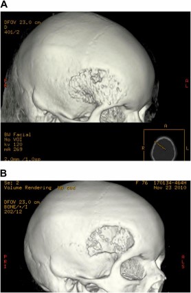 Postoperative cranioplasty radiographs. (A): Computed tomography (CT) image of cranioplasty with resorbable polylactic acid polymer-based mesh on the outer and inner cranium. (B): CT image of cranioplasty with resorbable polylactic acid polymer-based mesh with almost complete resorption of the autologous adipose-derived stem cell-seeded β-tricalcium phosphate-seeded construct.