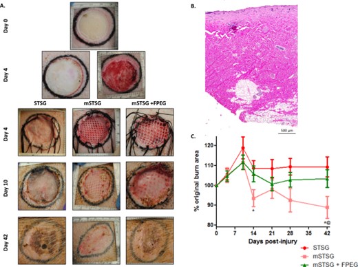 Photomicrographs and contraction of wounds treated with autografts. (A): Representative deep partial thickness burn wound (top) shows progression to day 4 post-burn, at which point wounds are debrided (2nd row right image). After debridement, wounds are covered with autografts with (mSTSG ± FPEG) and without (STSG) meshing (3rd row). Wounds on day 10 post-burn illustrate graft take, while contraction can be observed in day 42 post-burn wounds by comparing the tattoo markings. (B): Histological representation of debrided tissue shows excision spanned from the deep dermis into the subcutaneous adipose tissue. (C): Quantification shows enhanced contraction when autografts are meshed (mSTSG) compared with both nonmeshed grafts and those supplemented with FPEG. *, p < .01 versus STSG, *@, p < .05 versus mSTSG+ FPEG. Abbreviations: FPEG, PEGylated fibrin; mSTSG, meshed STSG; STSG, split thickness skin grafts.