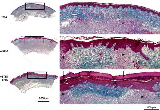 Microscopic appearance of grafts in wound beds on day 10 post-burn. Masson's trichrome staining on day 10 post-burn at ×10 magnification. Wounds treated with intact STSG show a continuous dermal layer covering granulation tissue. The mature epithelium complete with rete ridges is also visible in the mSTSG and mSTSG + FPEG groups where the dermal layer from the graft is visible. In the interstitial spaces between autograft, significant granulation tissue (asterisks) is covered by a newly formed, hyperplastic epithelium. In the mSTSG + FPEG group, the acellular FPEG hydrogel is stained red and seen superficial to the epithelium (scale bars are 2,000 and 500 µm). Abbreviations: FPEG, PEGylated fibrin; mSTSG, meshed STSG; STSG, split thickness skin grafts.