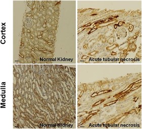 c-Kit cell immunochemistry in human kidneys. c-Kit cells are found in both cortex and medulla epithelial tubular cells from kidney biopsies of healthy individuals and deceased donors with acute tubular necrosis. Scale bars represent 50 μm for immunohistochemistry images.