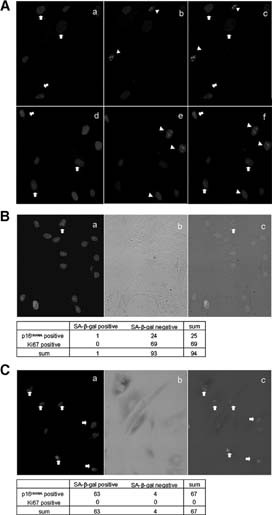 Association of p16INK4A with a marker of senescence but not that of proliferation. (A): Immunocytochemical staining of p16INK4A and Ki-67. (Aa–Ac): Human (h)MSC08 at population doubling (PD)23 (final PD was 25); (Ad–Af): hMSC45 at PD18 (final PD was 26). (Aa, Ad): p16INK4A staining. Signals are demonstrated as red dots in nuclei, and arrows indicate positive cells. (Ab, Ae): Ki-67 staining. Signals are demonstrated as blue dots in nuclei, and positive cells are indicated by arrowheads. (Ac, Af): Merged images. Note that most p16INK4A-positive cells were Ki-67-negative and vice versa. (B): Triple staining of p16INK4A, Ki-67, and SA-β-Gal in hMSC40 at PD6. (Ba), double staining of p16INK4A (red) and Ki-67 (green); (Bb), light field image of SA-β-Gal staining; (Bc), merged image of (Ba) and (Bb). Cells were classified by staining pattern, and the number of cells in each group is demonstrated in the table below the figures. (C): Identical experiments were performed using hMSC40 at a later passage (PD28). Abbreviation: SA-beta-gal, senescence associated-β-galactosidase.