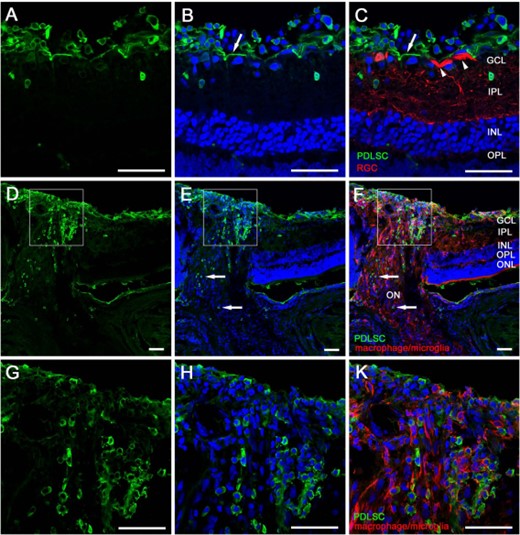 人PDLSCs的玻璃体内注射。PDLSC移植和视神经挤压术后3周视网膜横截面的共焦免疫荧光图像。人类PDLSC（绿色）用人类核特异性抗体染色。RGC经βIII-管蛋白呈红色染色。（A–C）：大多数注射的细胞位于RGC层，其中一些迁移到IPL和内核层。（D–F）：在视神经头中，PDLSC已沿神经纤维迁移，并到达层流前和层流后区域（箭头所示）。（G–K）：ON头部区域的放大图像。比例尺：50μm。缩写：GCL，神经节细胞层；INL，内核层；IPL，内丛状层；ON，视神经；ONL，外核层；OPL，外丛状层；牙周韧带源性干细胞；RGC，视网膜神经节细胞。