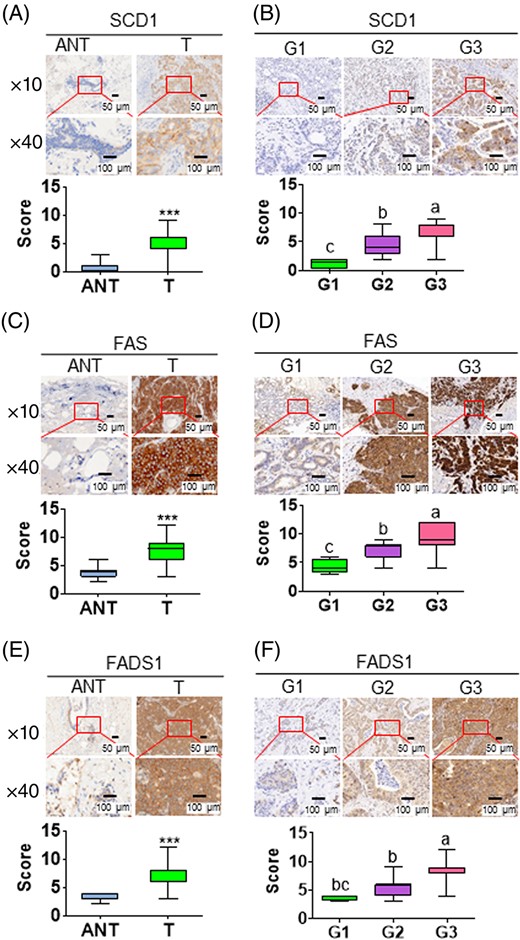 Increased expression of the lipogenic enzymes in human breast cancer tissues. A,C,E, Representative image of IHC analysis for SCD1 (A), FAS (C), and FADS1 (E) expressions in normal and tumor tissues. ANT, tumor-adjacent normal tissue; T, tumor. B,D,F, Representative image of immunohistochemistry (IHC) analysis for SCD1 (B), FAS (D), and FADS1 (F) expressions between various clinical and tumor grades (G1-3). ***P < .001 vs vehicle-treated control cells. Alphabet letters were used to show the significant difference between groups. Each subfigure contains representative image (top) and quantitative results (bottom). The quantitative results were plotted by the values of minimum to maximum