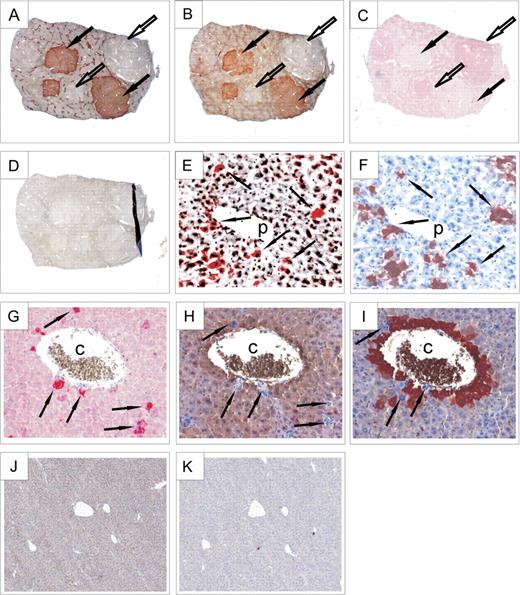 Expression of GSTm and other marker proteins in mouse liver as determined by immunohistochemical staining. (A) Staining for GS was used to identify tumors with Ctnnb1 mutations (GS positive); GS-negative tumors contained Ha-ras or B-Raf mutations. (B) GSTm protein was detected at high levels in GS-positive (Ctnnb1-mutated) tumors (designated by black arrows), whereas it was largely absent in GS-negative hepatomas (indicated by white arrows). Please also note zonation of GS and GSTm expression in neighboring normal liver tissue. (C) By contrast, E-cadherin expression, used to identify Ha-ras/B-raf–mutated tumors, was inversely correlated to GSTm and GS. (D) Control staining w/o primary antibody demonstrated the specificity of the detected signals. (E) Transgenic hepatocytes from a mouse with liver-specific expression of activated (S33Y) β-catenin displayed high levels of GSTm. Again, GSTm and GS expressions (F) were highly correlated (see arrows). (G) Cells from transgenic Tglox(pA)H-ras* mice expressing mutant Ha-ras were strongly stained for phosphorylated ERK1/2. Phospho-ERK1/2–positive hepatocytes expressed neither GSTm (H) nor GS (I). Expression of both GSTm (J) and GS (K) proteins was absent in mice with a liver-specific knock out of Ctnnb1, which is in strong contrast to the zonal expression pattern of these proteins in wild-type control mice (see A and B). Original magnification of images: ×2.5 (A–D), ×40 (E–I), and ×10 (J and K). p, portal vein; c, central vein.