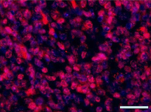 Representative immunofluorescence staining with anti-TTF-1. Tissue sections from nude mouse xenograft tumors produced by subcutaneous injection of arsenic-transformed human bronchial epithelial cells (As-p53lowHBEC-GFP) were stained with anti-TTF-1 (sc-13040; Santa Cruz Biotechnology Inc.) as previously described (Zhao et al., 2010). Nuclei were counterstained with 4′, 6-diamidino-2-phenylindole (DAPI) (blue). The overlaid fluorescence image was made from anti-TTF-1 staining (red color) and nucleus DAPI staining (blue color). Scale bar: 100 μm.