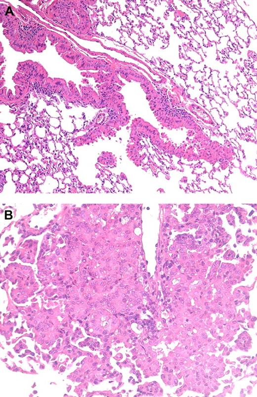 Representative picture of the bronchiolar-alveolar hyperplasia (A) and adenoma (B) observed in female mice receiving the high dose of fluensulfone (eosin–hematoxylin stained).