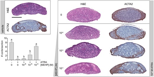 MEHP opposed the seminiferous cord disrupting effect of ATRA. Representative images of cultured fetal testes exposed to a concentration range of MEHP with or without 10−6 M ATRA for 3 days, labeled with hematoxylin and eosin, or immunohistochemically labeled for smooth muscle alpha actin (ACTA2). 10−6 M ATRA caused seminiferous cord disorganization and loss of cord structure, but this effect was opposed by MEHP. ACTA2 was expressed only at the periphery of the ATRA-treated testes. MEHP co-exposure prevented the loss of ACTA2 deposition at seminiferous cord basement membranes that was observed in ATRA-treated cultures Scale bar = 200 µm. ATRA decreased the number of identifiable seminiferous cords per section, but cord number was increased in a concentration-dependent manner by MEHP. On x-axis, “−” indicates no ATRA; “+” indicates 10−6 M ATRA. Values reported in chart are mean ± SEM. n = 24 testes in vehicle control group and 6–7 testes per treated group. Bars not connected by the same letter are significantly different by 1-way ANOVA followed by Tukey’s post hoc test. Overall ANOVA p < .0001. The full-color image is available online.
