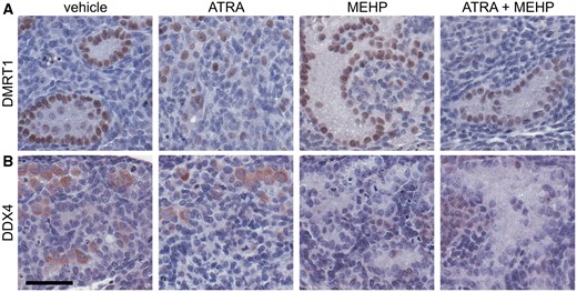 Germ cells were depleted by MEHP and co-exposure. A, Following 3 days of culture, DMRT1-expressing Sertoli cells are present in all samples. In ATRA treatment group, Sertoli cells are dispersed throughout section, but in all other groups, defined cords can be observed. B, Immunohistochemical labeling of the germ cell cytoplasmic marker DDX4 confirms that germ cells are present in seminiferous cords of 3-day cultures treated with vehicle media. Germ cells are largely present within well-defined cords, but occasionally present outside of cords. Following treatment with 10−6 M ATRA, fewer germ cells are visible, and they are outside of defined cords. 10−4 M MEHP and 10−6 M ATRA + 10−4 M MEHP cultures are largely devoid of germ cells, and sections show prominent germ cell-depleted cords. Scale bar = 50 µm. The full-color image is available online.