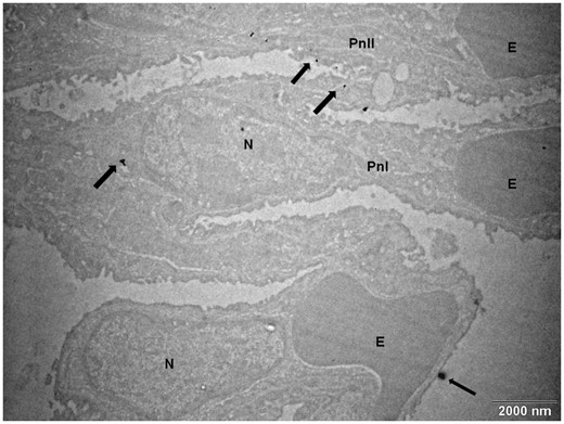 The transmission electron micrograph of ZnO NP (arrows) in pneumocytes after 3 months exposure to 1.93 × 106 ZnO NP/cm3. Abbreviations: E, erythrocyte; N, nucleus; Pn, pneumocyte.