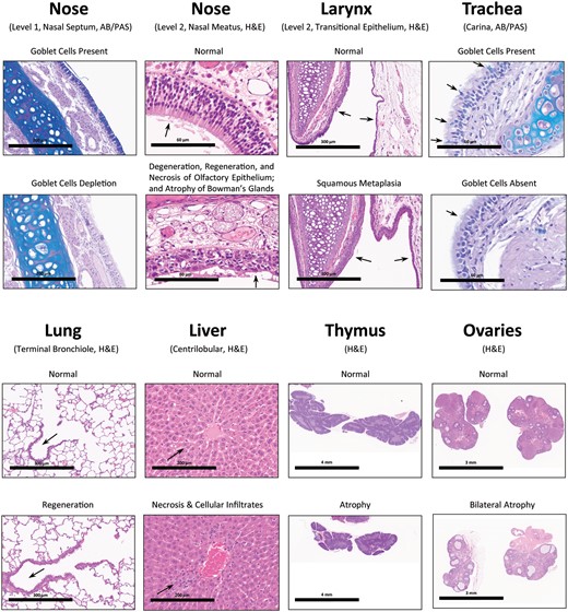Represe ntative non-neoplastic microscopic findings of the main Toxicology rats treated with High dose (50 mg/kg BW) of NNK by nose-only inhalation for 14 days. By comparing with control rats, significant non-neoplastic lesions were observed in High dose rats of both sexes. For example, in the nose: depletion of goblet cells from the mucosa of Level 1’s nasal septum (200 µm); and degeneration, regeneration, and necrosis of olfactory epithelium with atrophy of its underlying Bowman’s glands (60 µm). In the larynx: squamous metaplasia (300 µm). In the trachea: depletion of goblet cells (60 µm). In the lung: regeneration of bronchiolar epithelium (300 µm). In the liver: centrilobular necrosis (centrilobular single cell necrosis) and centrilobular cellular infiltration of mononuclear cells (200 µm). In the thymus: atrophy (4 mm). In the ovaries (female): bilateral atrophy (3 mm).