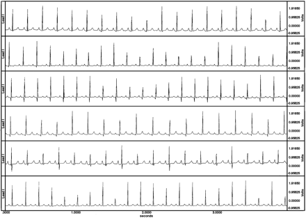 Bipolar, transthoracic ECGs from 6 of the 12 conscious guinea pigs. Notice the absence of baseline artifacts, the ease of identification of the onset of QRS and the end of T, and the fluctuations in height of R waves as the guinea pigs breath.