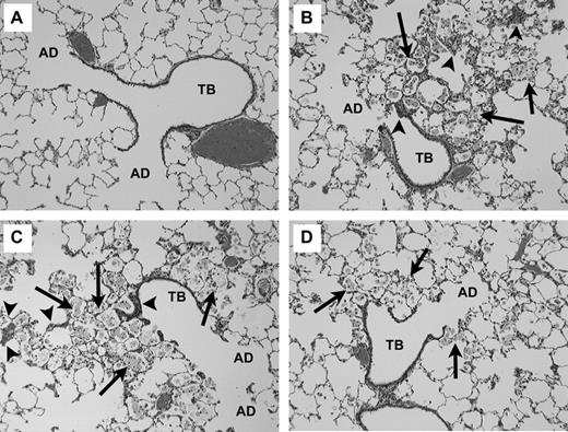 Light micrograph of lung tissue from rats exposed to particles (5 mg/kg) at 3 months postinstillation exposure. Each micrograph illustrates the terminal bronchial (TB) and corresponding alveolar ducts (AD). (A) CI particles: Demonstrates normal lung architecture following CI exposures. (B) Min-U-Sil quartz particles: the tissue accumulation of foamy alveolar macrophages (arrows) within alveolar spaces. (C) Nanoquartz II: the tissue accumulation of foamy alveolar macrophages (arrows) within alveolar spaces. (D) Fine-quartz particles: the tissue accumulation of foamy alveolar macrophages (arrows) within alveolar spaces. For graphs B–D, the macrophages have migrated to the sites of quartz particle instillation at the terminal bronchiolar alveolar junctions. The accumulation of lipid-filled macrophages, lack of clearance, and development of tissue thickening (arrowhead) are common features of the progressive nature of silica-induced lung disease (magnification = ×100).