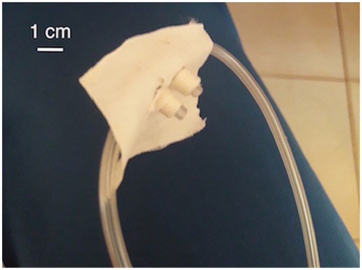 Optimized nasal interface. Three pieces of tape were used to seal the area for reduced air leakage; implemented on day 3.
