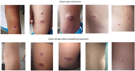 Evolution of lesions with sodium stibogluconate treatment.
