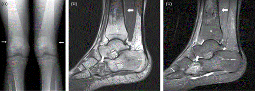 GD in a 13-year-old patient. (A) AP radiograph of the knees demonstrates the characteristic Erlenmeyer flask deformity of both distal femurs (thin arrows) with thin cortices consistent with osteopenia. (B) T1W and (C) STIR sagittal MR images of the ankle demonstrate areas of heterogeneous signal in the distal tibia and cuboid bone consistent with areas of ON (thick arrows). Heterogeneous signal within the calcaneus and proximal fifth metatarsal is abnormal (thin arrows), which may represent ON. Areas of normal fatty marrow (asterisk) caused by ERT are present.