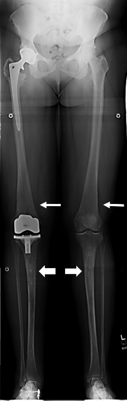 GD in a 42-year-old patient. A stitched leg length series demonstrates Erlenmeyer flask deformities (thin arrows) and patchy osteosclerosis of the tibial shafts caused by ON (thick arrows). Right hip and knee joint replacements were caused by secondary OA from ON.