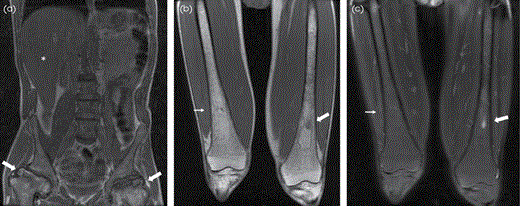 MRI of GD in a 45-year-old man. (A) Large field-of-view (FOV) T1W image demonstrates diffusely abnormal marrow signal with femoral head ON with articular surface collapse (thick arrows) and hepatomegaly (asterisk). Coronal T1W (B) and T2W with FS (C) images demonstrate diffuse marrow heterogeneity from ON (thick arrow) with asymmetric Erlenmeyer flask deformity on the right (thin arrow).