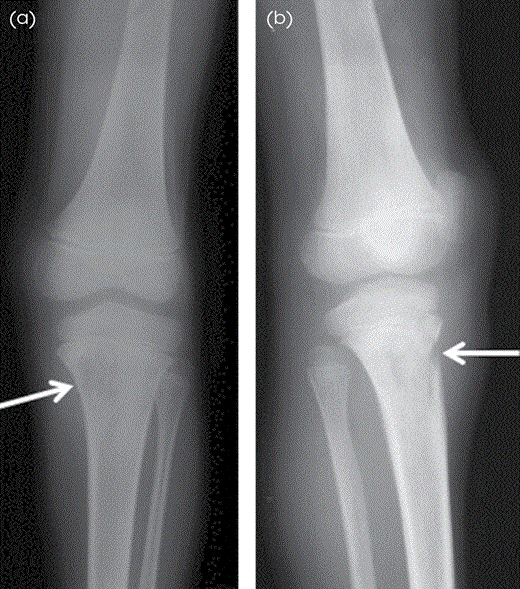 Acute OM of the left tibia in an 18-year-old man. (A) AP and (B) oblique radiographs of the tibia and fibula show permeative bone destruction (arrows) involving the proximal metaphysis of the left tibia. The lesion has wide zone of transition. There is cortical break noted anteriorly with adjacent soft tissue edema.