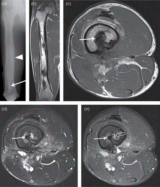 Chronic OM of the right femur in a 32-year-old man. (A) AP radiograph of the right femur shows cortical thickening, osseous expansion and bony remodeling, sclerotic changes, sequestrum (arrow), and involucrum (arrowhead). Coronal (B) and (C) axial T1W, (D) axial T2W FS, and (E) axial postcontrast T1W FS MR images show diffuse cortical thickening involving the right femur with medullary sequestrum (arrow), which is hypointense on all sequences, enhancing surrounding granulation tissue (open arrow) and cloaca (arrowhead), which is seen as a cortical defect.