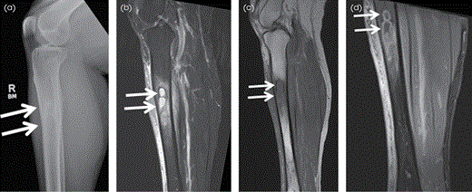 Brodie abscess in the right tibial diaphysis in a 48-year-old woman. Lateral radiograph (A) shows a bilobed lucent lesion with a thin sclerotic rim in the proximal tibial diaphysis consistent with Brodie abscess (arrows). (B) The lesion demonstrates high signal intensity on the sagittal STIR MR image with associated low signal rim of sclerosis (arrows) and adjacent high signal BME. On the sagittal T1W MR image (C) the lesion shows central low signal with higher/intermediate signal intensity rim (penumbra sign) and surrounding low signal sclerosis (arrows) and demonstrates rim enhancement (arrows) on the postcontrast T1W FS MR image (D) with enhancing adjacent BME.